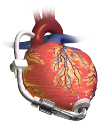 Advanced therapy for Heart Failure : surgical approaches 